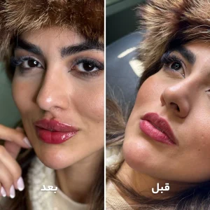 تزریق ژل لب در کلینیک مهرزاد