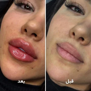 تزریق ژل لب در کلینیک مهرزاد