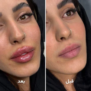 تزریق ژل لب در کلینیک مهرزاد