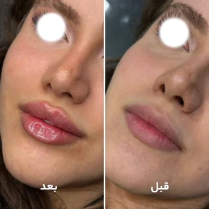 تزریق ژل لب در کلینیک مهرزاد