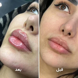 تزریق ژل لب در کلینیک مهرزاد