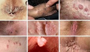 زگیل تناسلی که حاصل ویروس HPV است دقیقا چیست؟