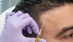 درمان ریزش مو با PRP : استفاده از پلاسمای غنی از پلاکت خون فرد