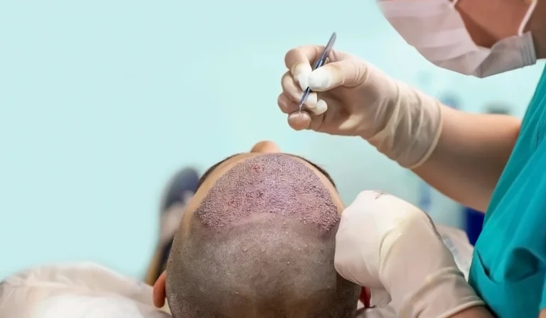 پیوند مو از فردی دیگر چگونه انجام می شود و چه محدودیتهایی دارد؟