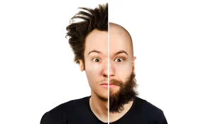 کاشت مو از ریش به سر : استخراج فولیکولهای موی ریش