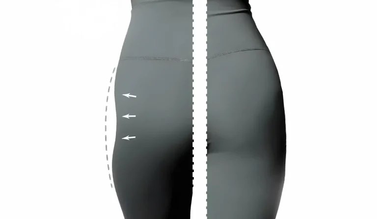 هیپ دیپ یا گودی بغل ران: برای درمان آن چه روشی مناسب است؟