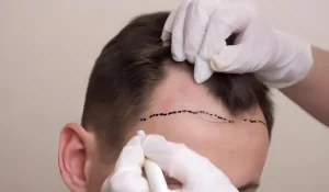 کاشت مو به روش HRT : روشی غیر جراحی برای بازیابی موهای از دست رفته