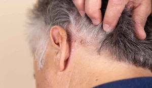 خارش سر بعد از کاشت مو : آیا طبیعی است؟