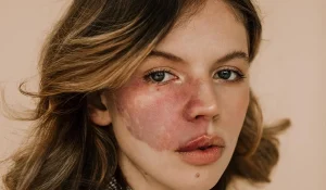 لیزر ماه گرفتگی : چه کسانی مناسب این کار هستند؟