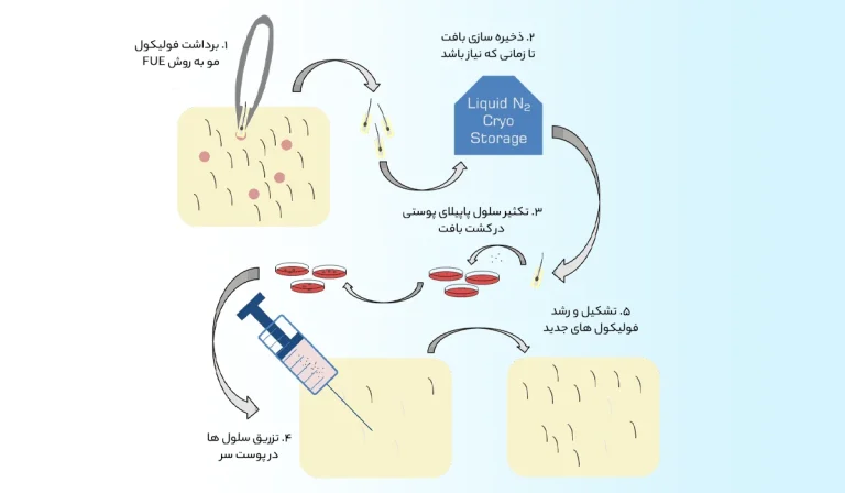 نیدل کلونر (کلونینگ مو) چیست؟ آیا در ایران انجام می شود؟