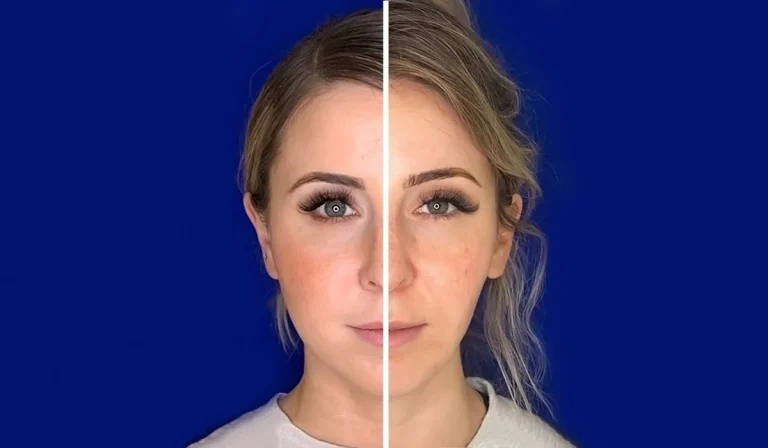 16 روش برای چاق شدن صورت : به صورت طبیعی، تزریقی و جراحی