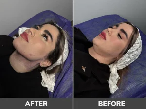 بهترین کلینیک لیپوساکشن غبغب در تهران