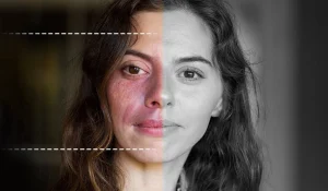 ماه گرفتگی پوست یا خال مادرزادی چرا و چگونه اتفاق میافتد؟