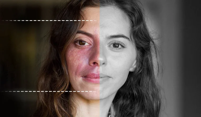 ماه گرفتگی پوست یا خال مادرزادی چرا و چگونه اتفاق میافتد؟