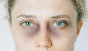 کبودی بعد از تزریق فیلر : طبیعی و رایج است؟