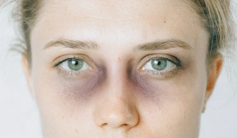 کبودی بعد از تزریق فیلر : طبیعی و رایج است؟