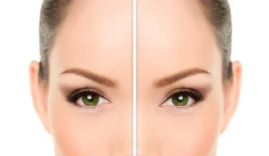 بلفاروپلاستی چشم گربهای : کشیدن چشمها برای زیبایی بیشتر