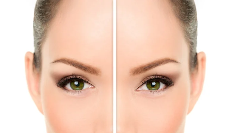 بلفاروپلاستی چشم گربه‌ای : کشیدن چشمها برای زیبایی بیشتر