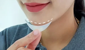 پروتز چانه : بهبود ظاهر چانه و بهبود تناسب صورت