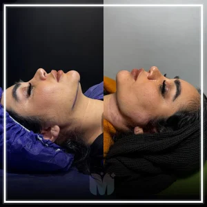 بهترین کلینیک لیپوساکشن غبغب در تهران