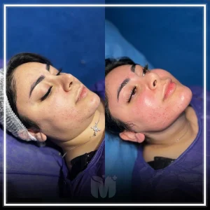 بهترین کلینیک لیپوساکشن غبغب در تهران