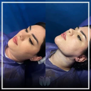 بهترین کلینیک لیپوساکشن غبغب در تهران