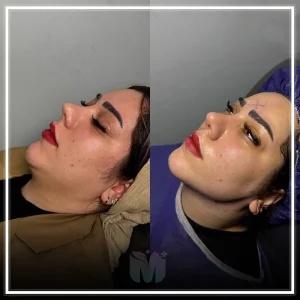 بهترین کلینیک لیپوساکشن غبغب در تهران