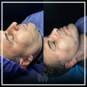 بهترین کلینیک لیپوساکشن غبغب در تهران