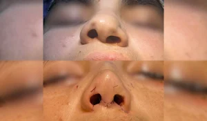 اصلاح بینی کج : روشهای ترمیم چگونه است؟