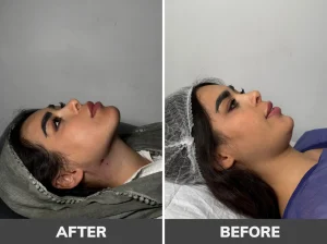 بهترین کلینیک لیپوساکشن غبغب در تهران