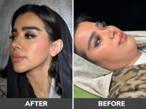 بهترین کلینیک لیپوساکشن غبغب در تهران