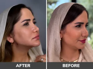 بهترین کلینیک لیپوساکشن غبغب در تهران