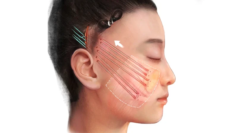 لیفت میدفیس : جوانسازی با تمرکز بر ناحیه میانی صورت