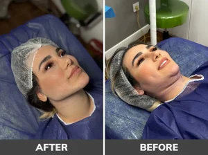 بهترین کلینیک لیپوساکشن غبغب در تهران