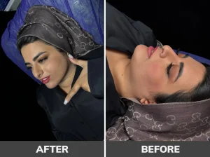 بهترین کلینیک لیپوساکشن غبغب در تهران