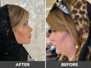 بهترین کلینیک لیپوساکشن غبغب در تهران
