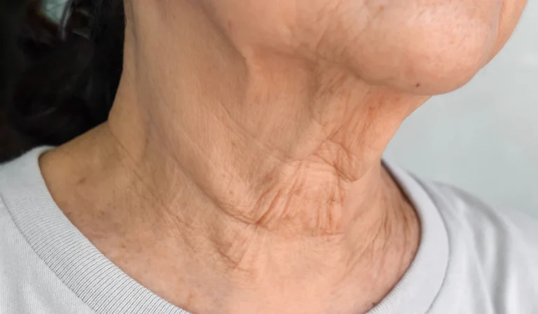 درمان چروک گردن : آشنایی با انواع روش‌های خانگی و جراحی