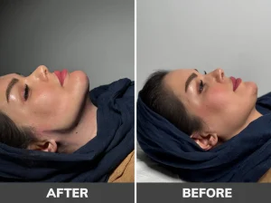 بهترین کلینیک لیپوساکشن غبغب در تهران