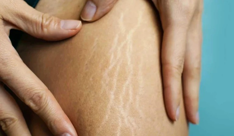 ۱۰ روش برای درمان ترک‌های پوستی (استرچ مارک‌ها)