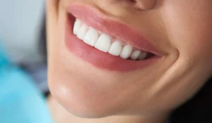 ۲۰ مدل پرطرفدار کامپوزیت دندان : از طبیعی تا فانتزی