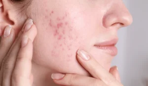 اسکار آکنه : التهاب و جای زخمهای ناشی از جوش