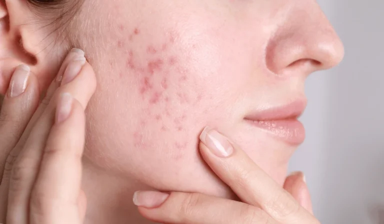 اسکار آکنه : التهاب و جای زخم‌های ناشی از جوش