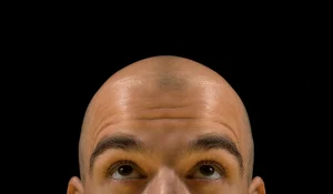 تراشیدن یا کچل کردن برای کاشت مو : آیا حتما باید سر را کاملا تراشید؟