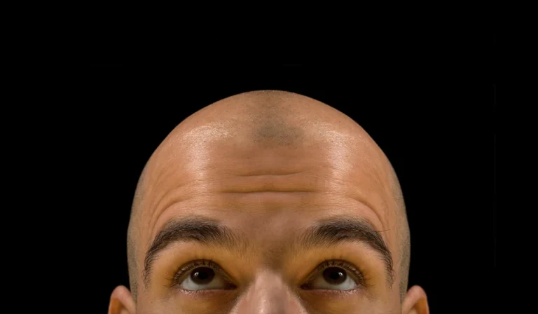 تراشیدن یا کچل کردن برای کاشت مو : آیا حتما باید سر را کاملا تراشید؟