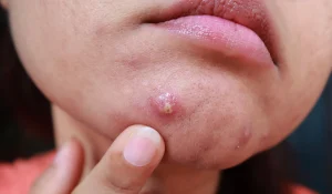 جوش چانه : از تغییرات هورمونی تا ماسک زدن! راههای درمان چیست؟