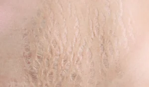 لیزر ترک پوستی : درمانی نوین برای از بین بردن استرچ مارکها