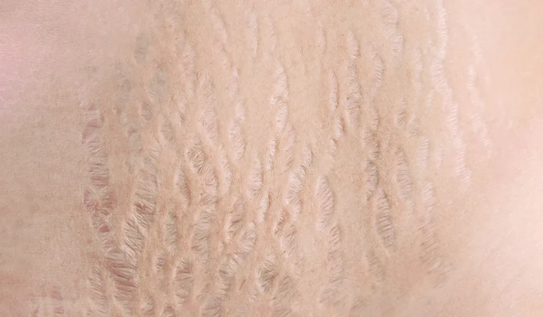 لیزر ترک پوستی : درمانی نوین برای از بین بردن استرچ مارک‌ها