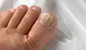 قارچ ناخن : از تغییر رنگ تا ضخیم شدن غیرطبیعی ناخن ها