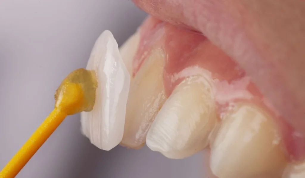 تفاوت لمینت و کامپوزیت دندان : نوع جنس و روش انجام و ماندگاری