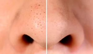 جوش سر سیاه : راه رهایی از این مهمان سرسخت پوست